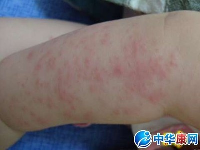 症状