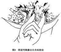 穹隆
