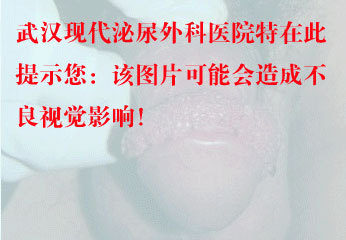 溃烂