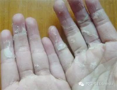 手痒