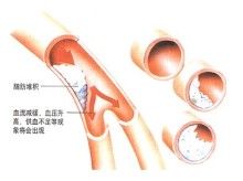 血脂