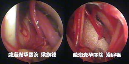 痉挛