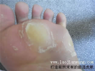 老茧
