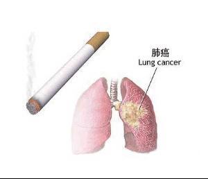 肺癌
