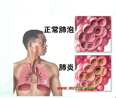 肺炎