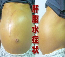 腹水