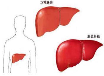 肝炎