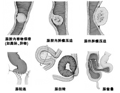 梗阻