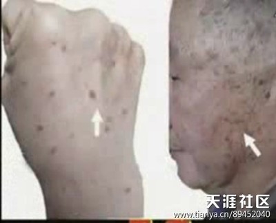 黑斑