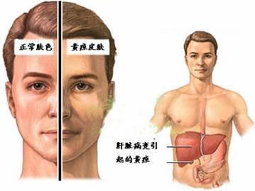 黄疸