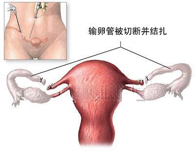 结扎