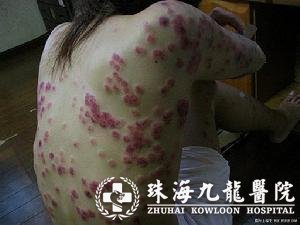 淋病