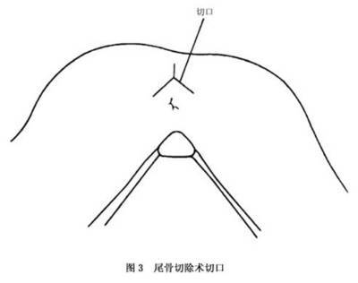 尾骨