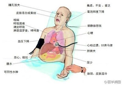 心衰