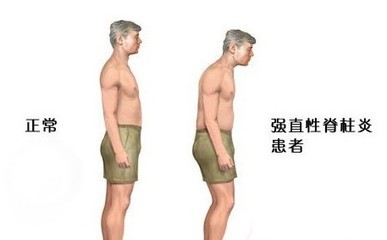强直