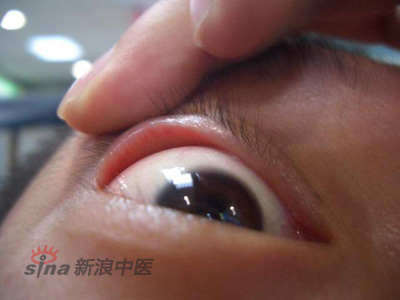 砂眼