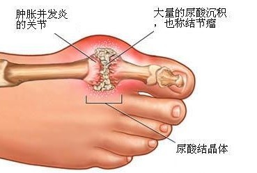 痛风