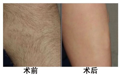 脱毛